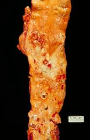Imagen:Atherosclerosis, aorta, gross pathology PHIL 846 lores.jpg